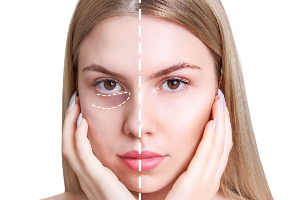 Say Goodbye To Dark Circles With Tear Trough Fillers